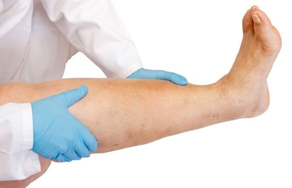 Swelling of the leg
