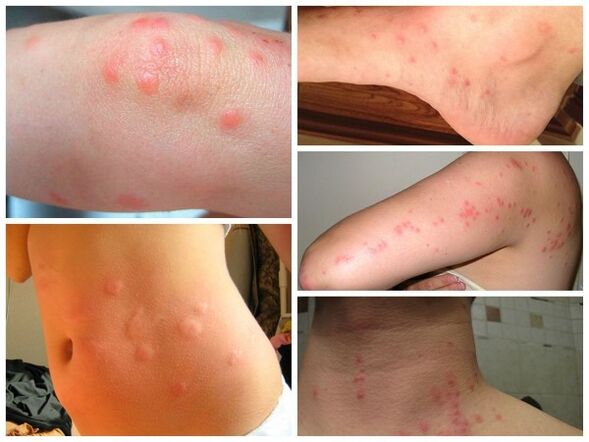 skin parasites