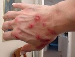Papules on the skin with helminthiasis