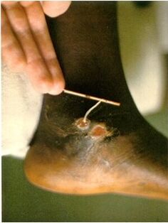 Guinea worm extracted from the leg of a person suffering from Guinea worm